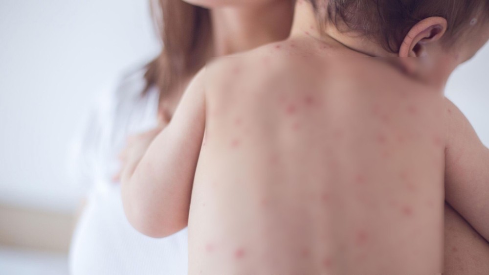 ХӨСҮТ: Улаанбурхан өвчины улмаас долоон хүн энджээ